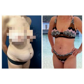 before-after photo liposuction