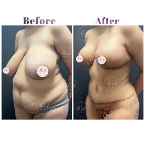 before-after photo liposuction