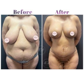 before-after photo liposuction