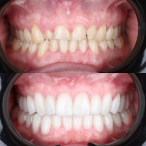 before-after photo installation-of-a-veneer