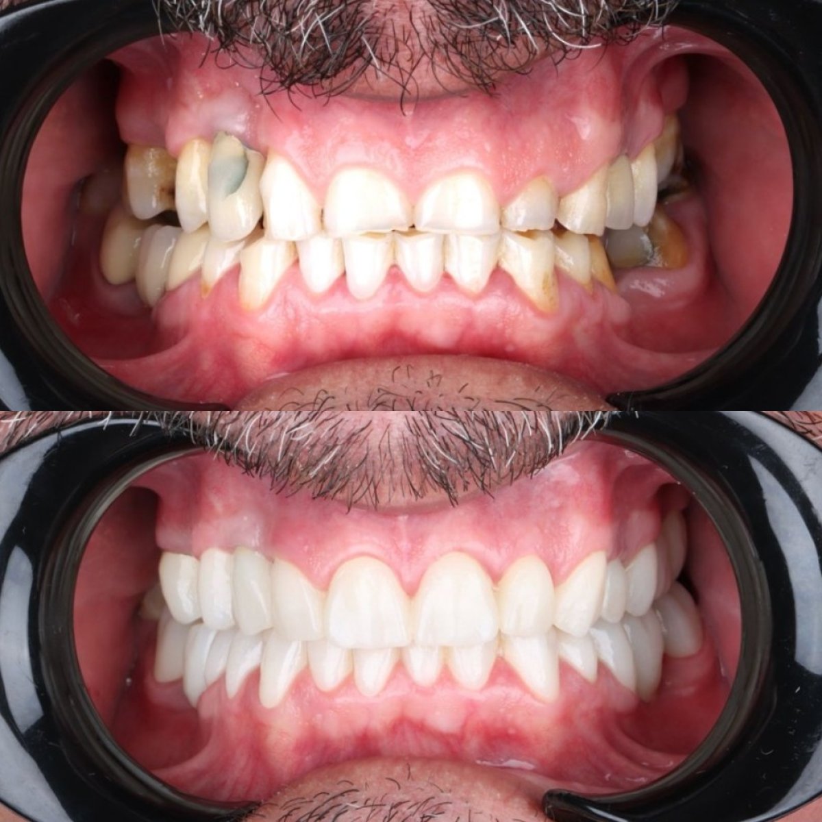 نتائج قبل وبعد الفينير في عيادة D'art Dental Clinic، ابتسامة بيضاء طبيعية
