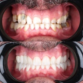 before-after photo installation-of-a-veneer
