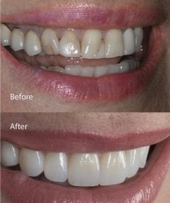 before-after photo dental-implant