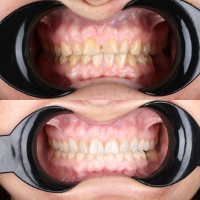 before-after photo installation-of-a-veneer
