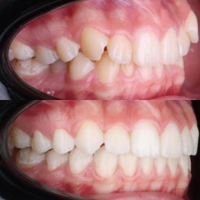 before-after photo invisalign