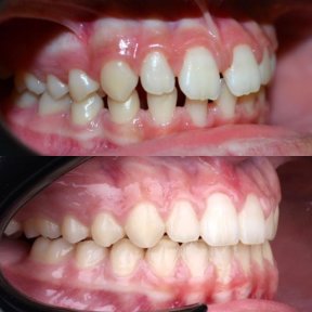 before-after photo invisalign