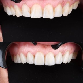 before-after photo installation-of-a-veneer