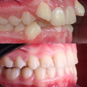 before-after photo invisalign