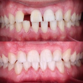 before-after photo invisalign