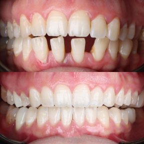 before-after photo invisalign