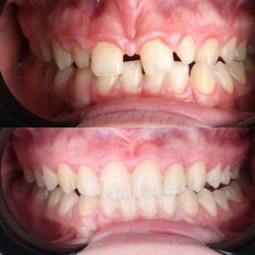 before-after photo invisalign