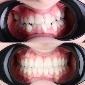 before-after photo invisalign