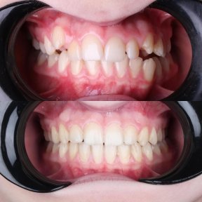before-after photo invisalign