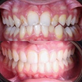 before-after photo invisalign