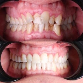 before-after photo invisalign