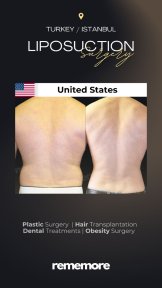 before-after photo hair-transplant