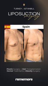 before-after photo hair-transplant
