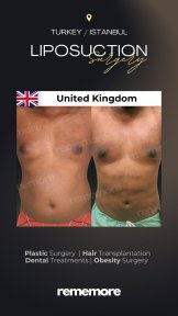 before-after photo hair-transplant