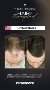 before-after photo hair-transplant