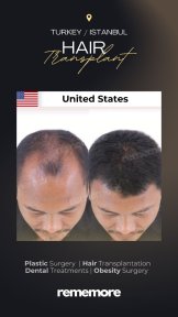 before-after photo hair-transplant