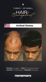 before-after photo hair-transplant