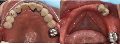 before-after photo dental-implant