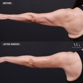 Before and after arm lift results at VG Plastic Surgery, improved arm contour after 2 weeks