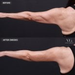 Before and after arm lift results at VG Plastic Surgery, improved arm contour after 2 weeks