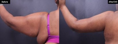 Before and after arm liposuction results at VG Plastic Surgery – improved arm contour visible
