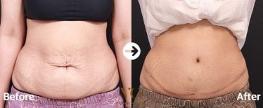 Before and after tummy tuck and liposuction results at VG Plastic Surgery, flatter abdomen