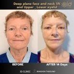 Before and after facelift, neck lift, eyelid surgery results at ID Clinic Bangkok, 14 days post-op