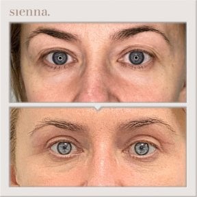 Before and after facelift results at Sienna Clinic, visible eye area rejuvenation