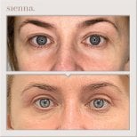 Before and after facelift results at Sienna Clinic, visible eye area rejuvenation