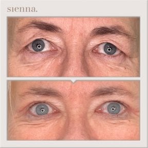 Before and after facelift results at Sienna Clinic – visible eye area rejuvenation