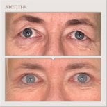 Before and after facelift results at Sienna Clinic – visible eye area rejuvenation