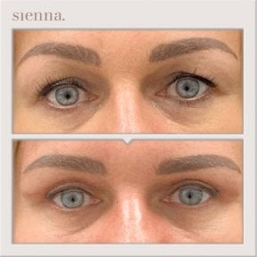 Before and after facelift results at Sienna Clinic, visible eye area rejuvenation