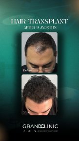 Before and after DHI hair transplant results at Grand Clinic, 9 months post-procedure