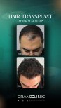 Before and after DHI hair transplant results at Grand Clinic, 9 months post-procedure
