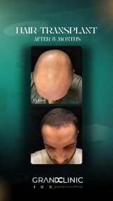 Before and after DHI hair transplant at Grand Clinic, 8 months result with fuller hairline