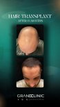 Before and after DHI hair transplant at Grand Clinic, 8 months result with fuller hairline