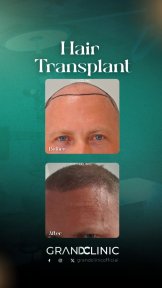 Before and after DHI hair transplant results at Grand Clinic – restored hairline in male patient