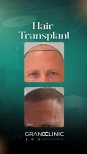 Before and after DHI hair transplant results at Grand Clinic – restored hairline in male patient