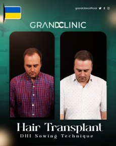 Before and after DHI hair transplant results at Grand Clinic, improved hair density visible