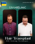 Before and after DHI hair transplant results at Grand Clinic, improved hair density visible