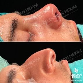 Before and after open rhinoplasty results at Lokman Hekim Istanbul Hospital, nose reshaping
