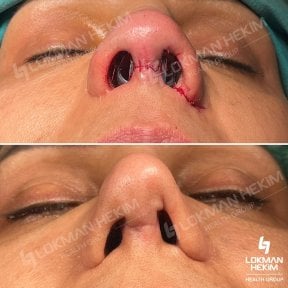 Before and after open rhinoplasty results at Lokman Hekim Istanbul Hospital, improved nose shape