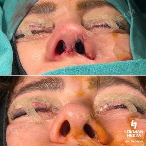 Before and after open rhinoplasty results at Lokman Hekim Istanbul Hospital, improved nose shape