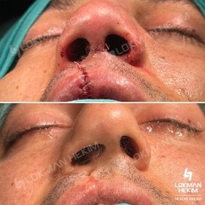 Open rhinoplasty before and after results at Lokman Hekim Istanbul Hospital, improved nose shape