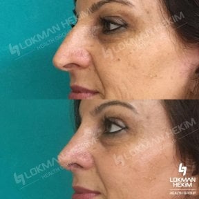 Before and after open rhinoplasty results at Lokman Hekim Istanbul Hospital, nose reshaping