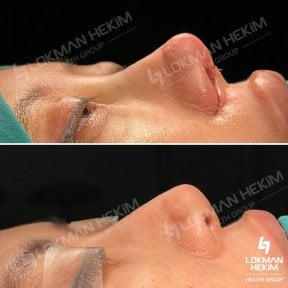 Before and after open rhinoplasty results at Lokman Hekim Istanbul Hospital, nose reshaping